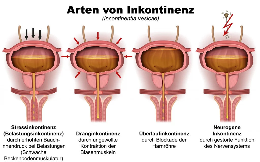 Arten von Inkontinenz im Überblick