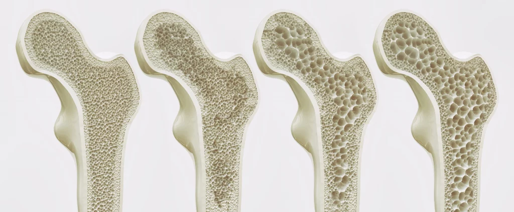 Vier Knochen im Querschnitt von innen die die vier Stadien von Osteoporose aufzeigen