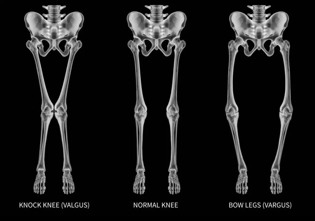 Drei Röntgenbilder von dem Unterkörper eines Menschen. Links X-Beine, mittig normale Knie und rechts O-Beine.