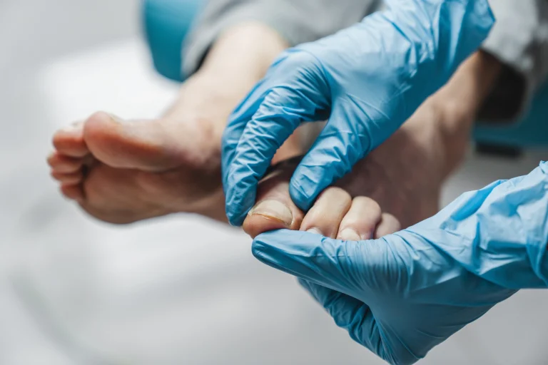 Ein Arzt mit blauen Latexhandschuhen behandelt den Nagelpilz eines Patienten.