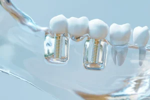Eine transparente Darstellung des Kieferknochens mit teilen einer Zahnprothese.