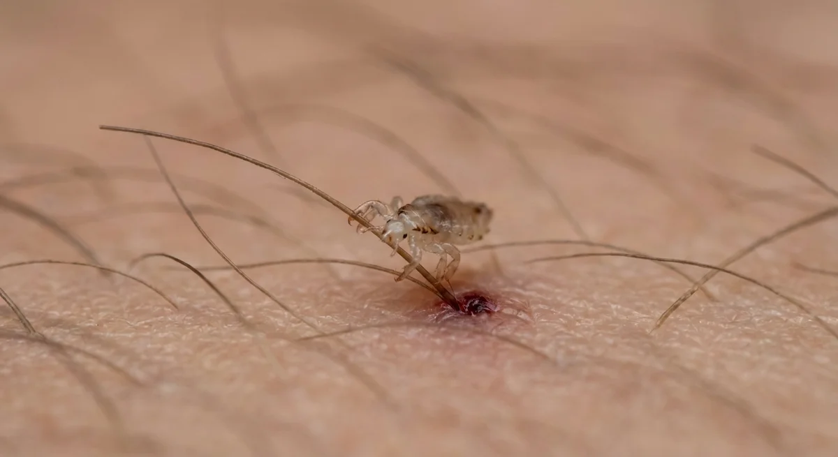 Filzlaus (Pthirus pubis) in typischer Umgebung – Befall erkennen und bekämpfen